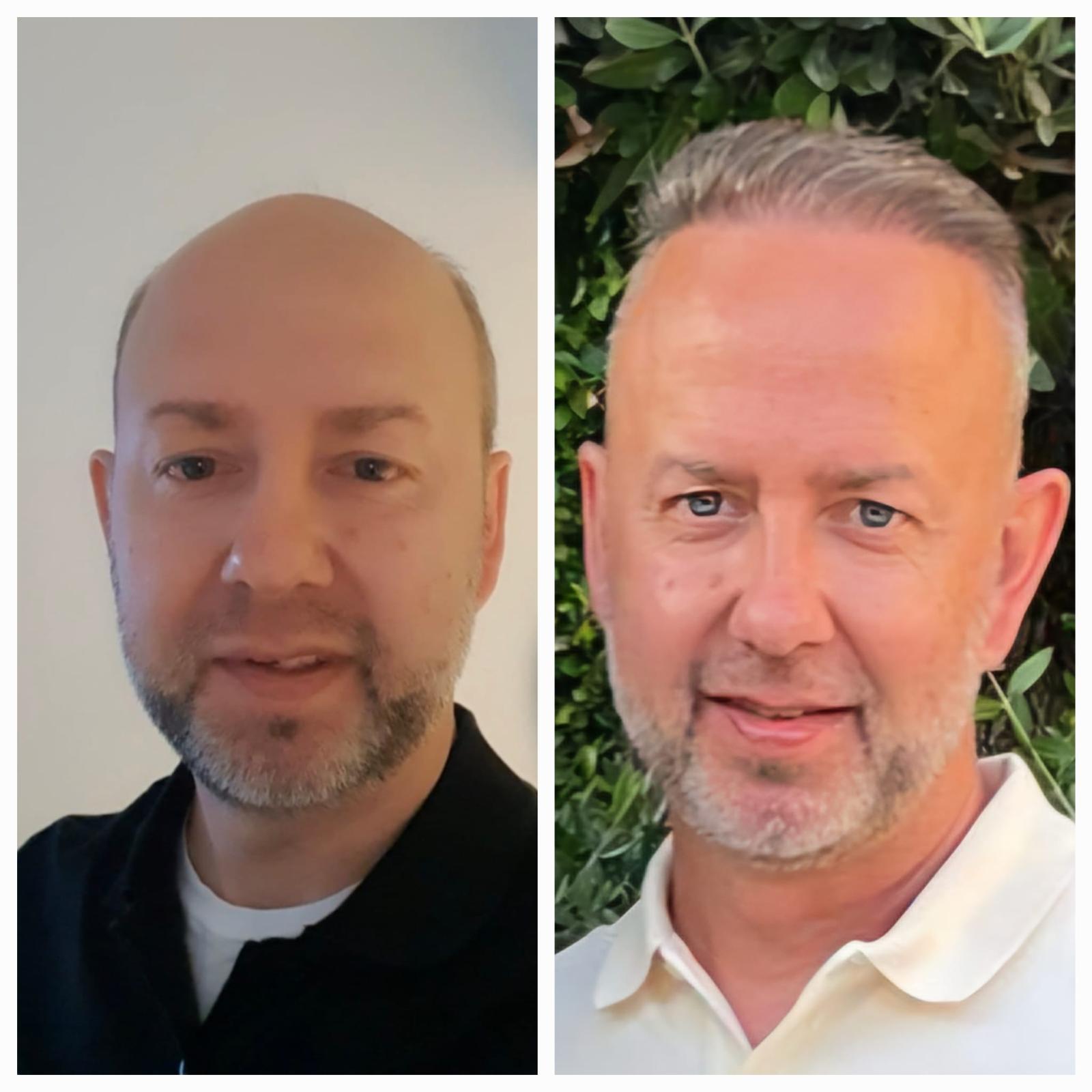 Haartransplantation