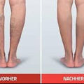 Sklerotherapie komplett