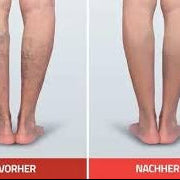 Sklerotherapie komplett